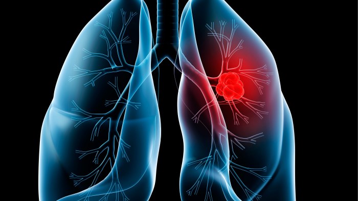 Lung cancer hesi case study