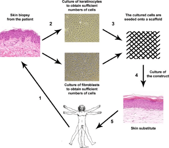 Autologous vs nonautologous tissue substitute